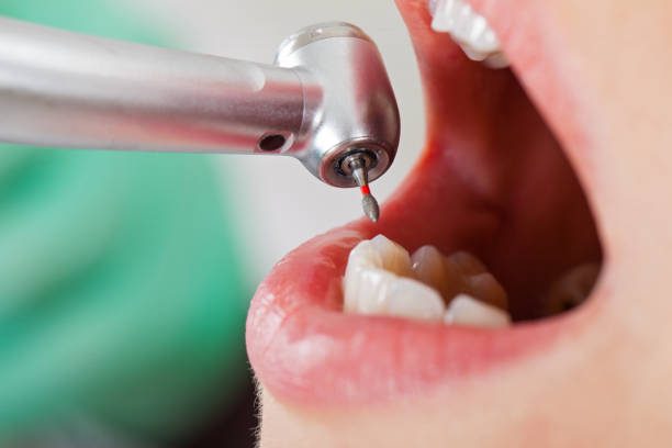 Best Urgent Tooth Repair  in Hilton, NY